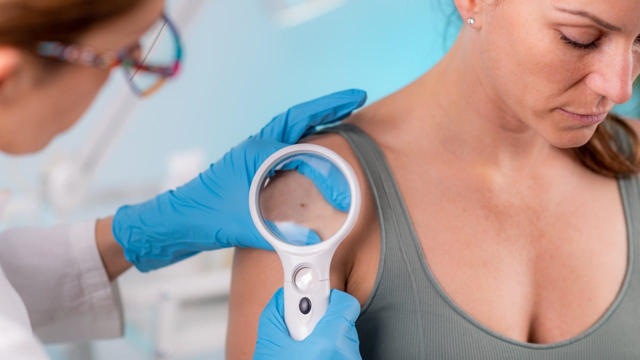 Unimed Cuiabá reforça que a melhor forma de evitar o câncer de pele é se proteger do sol